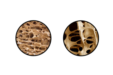 Différence de densité osseuse entre un os sain et un os atteint d'ostéoporose.